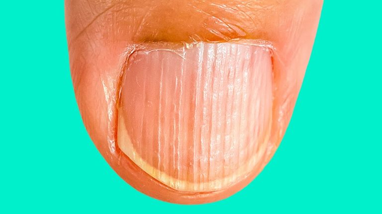 Gestreepte nagels: hoe u hun oorspronkelijke vorm en uiterlijk kunt herstellen
